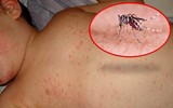 [ẢNH] Những loại bệnh dịch phổ biến do thời tiết ở Việt Nam